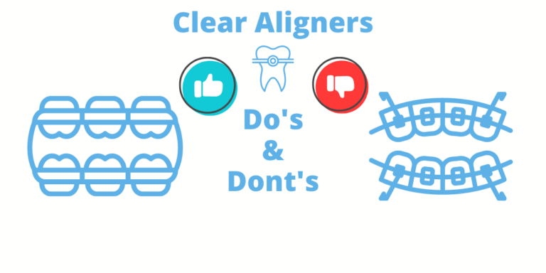 Dental Advice: Everything You Need to Know about Clear Aligners