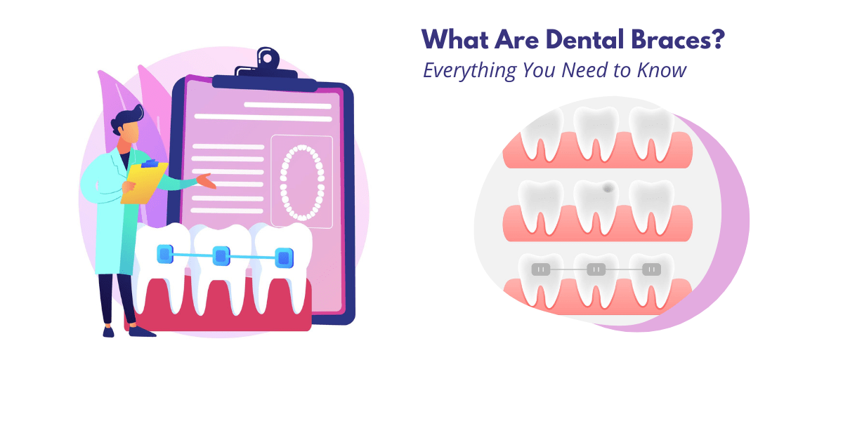 All You Need to Know About  Dental Braces: Types, Cost, How They Work, and More